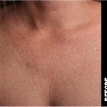Ultherapy Before & After Patient #1556